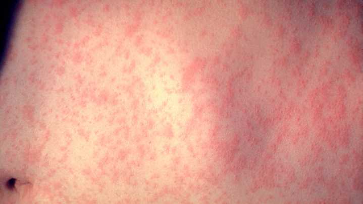 Measles cases confirmed in Marquette County