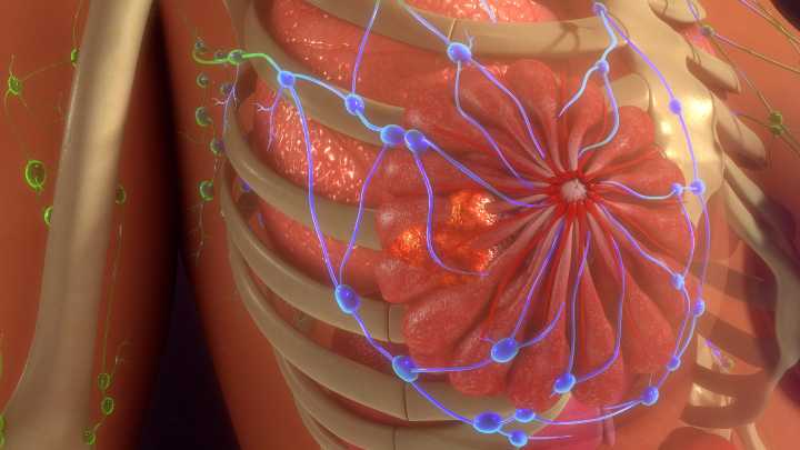 Neutrophils Found to be Culprits in Advanced