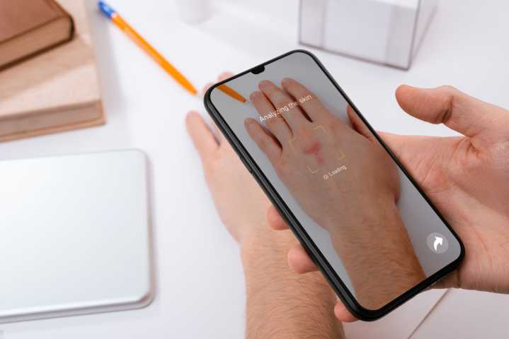 Skin Cancer Detection Apps Shown Vulnerable to Camera Sticker Hacks, Study Finds