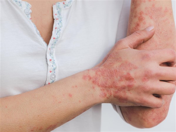 3 skin conditions compete for attention, triggered by the immune system and more
