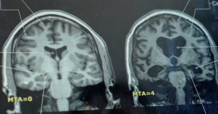 CDC confirms Texas woman died from brain-eating amoeba after using tap water for nasal rinse