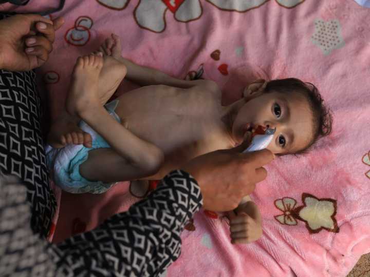 UN warns of surge in acute malnutrition among Gaza’s young children