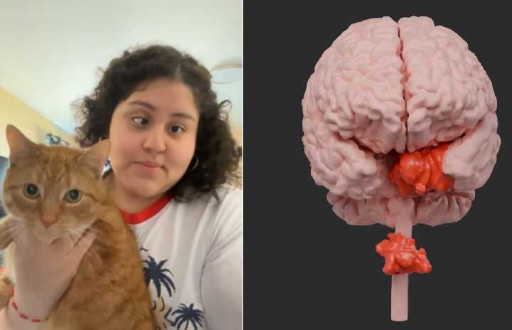 Thanks to MRI Mistake Second Tumor Is Found on Woman’s Spine: a Pioneering Procedure Removed Both