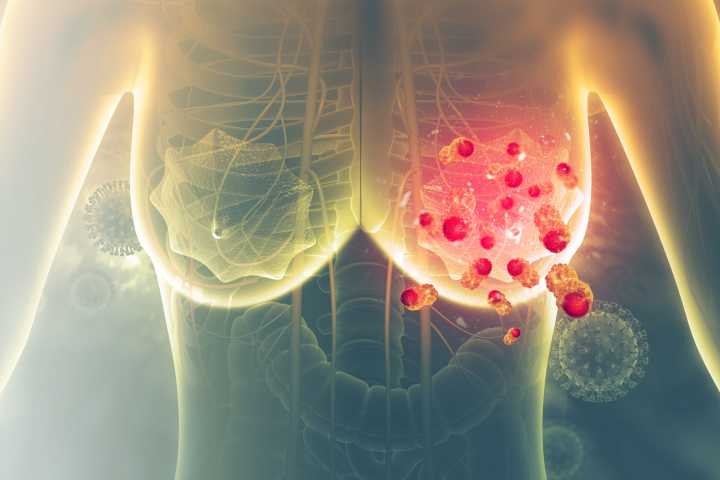 First AI Platform for Breast Cancer Risk Prediction Approved By FDA