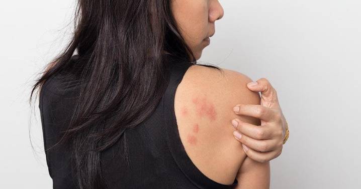 ¿Tiene urticaria? Lo que le interesa saber sobre la urticaria crónica