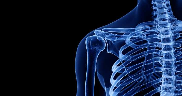 Superior capsular reconstruction, bridging graft both viable for massive rotator cuff tears