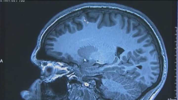 Alzheimer’s affects 1 in 9 seniors — here are the early signs to watch for
