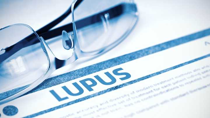 ACR Releases New Guideline for Lupus Treatment
