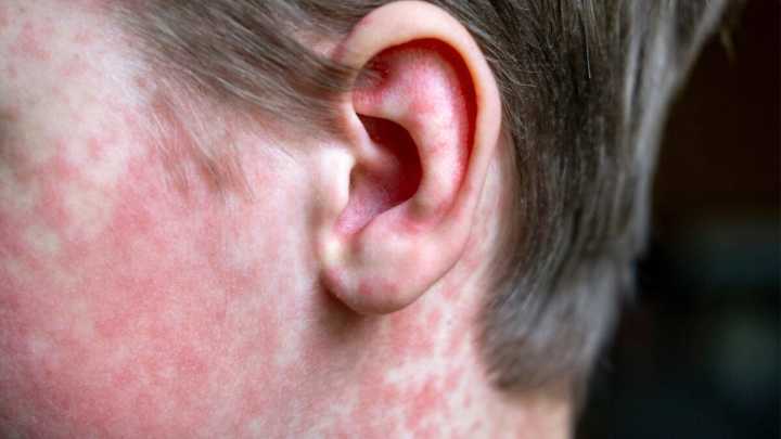 Premature Newborn Dies in Ontario After Catching Measles From Unvaccinated Mother