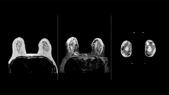 AI-Directed Breast MRI Could Lead to Faster Scan Times Without Affecting Accuracy