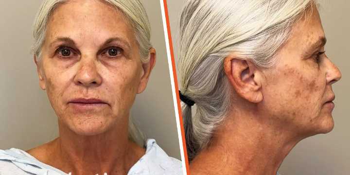 At 65, This Woman Had 6-Hour Plastic Surgery After She Stopped Recognizing Herself – Her Before & After Photos