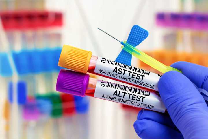 What to do if your liver enzymes are elevated