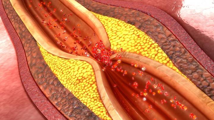 Low-Dose Colchicine May Help Stabilize Coronary Plaques
