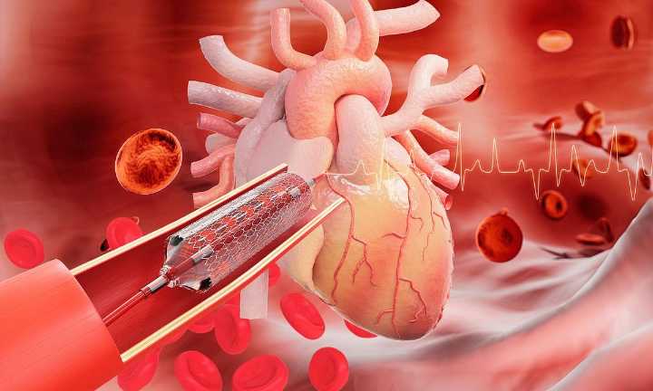 P2Y12 Inhibitor Monotherapy Beneficial for Patients Who Undergo PCI