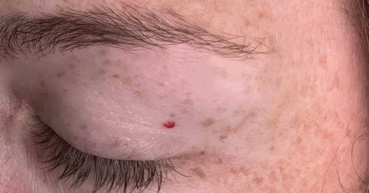 What to expect at a full-body skin check