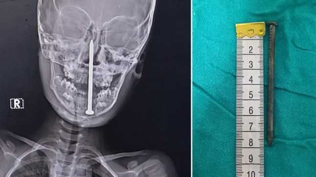 Man ‘drove three-inch nail into girl’s brain to stop her revealing sex abuse’