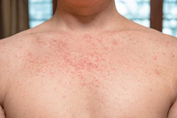 LACo Public Health Confirms Local Measles Case
