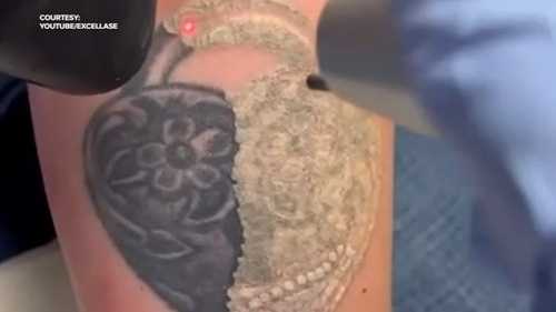 'Tattoo regret' driving business at laser removal clinics in NC: 'Think before you ink'
