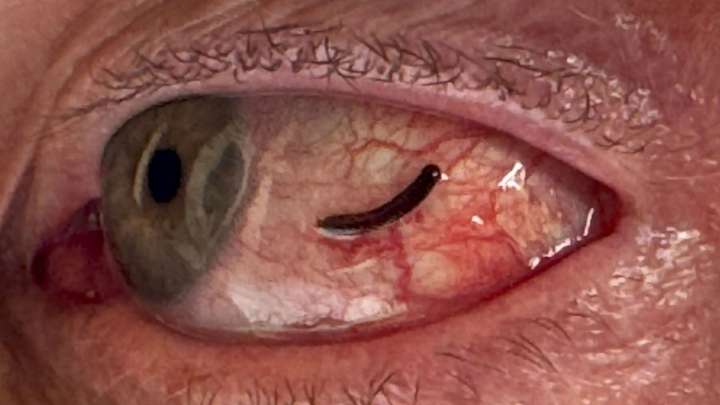 Horrifying photos show the true cause of man's itchy eye - after he found a LEECH feasting on his eyeball