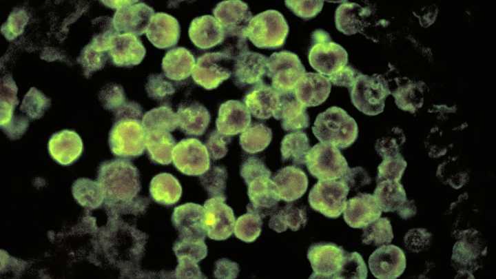 Woman killed by brain-eating amoeba after cleaning sinuses with water in Texas: CDC