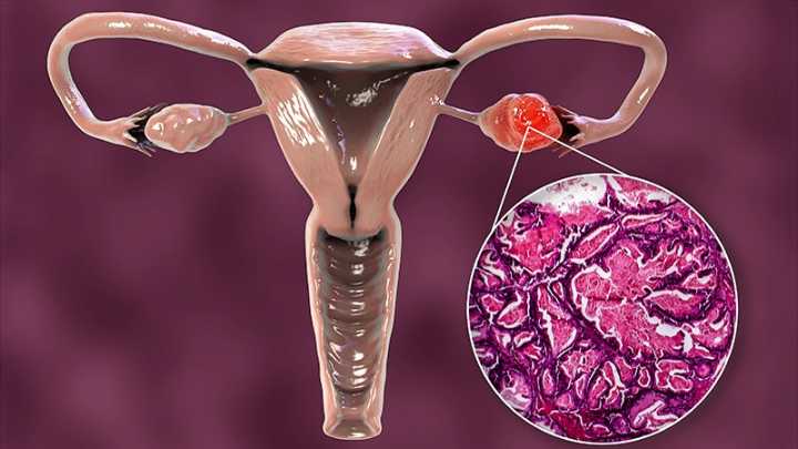 Surgery Before or After Chemo for Advanced Ovarian Cancer?
