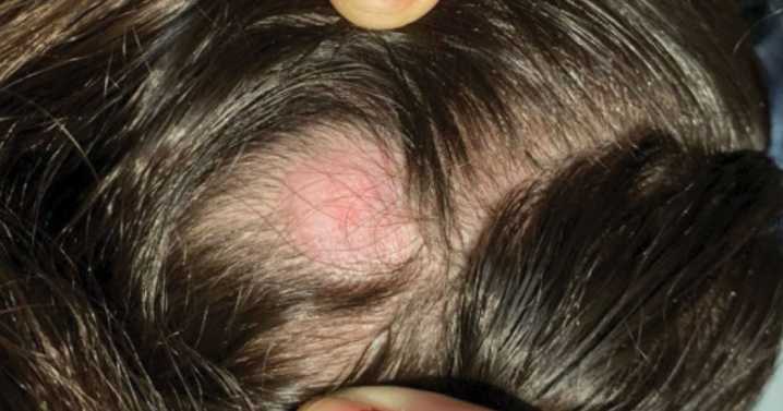 Girl presents with acute vision loss in left eye