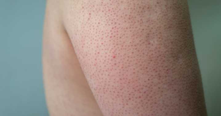 So THAT's What Those Tiny Non-Itchy Bumps On Your Arm Are