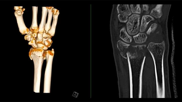 Dual-Energy CT Boosts Diagnostic Accuracy in Arthritis