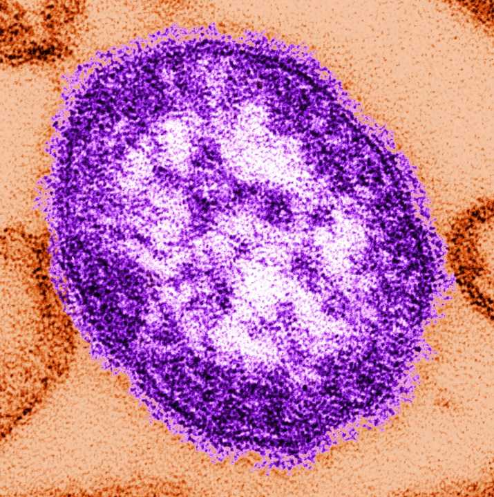 Two more measles cases confirmed in Williams County