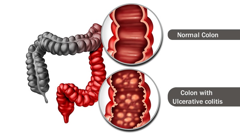 Obefazimod Shows Long-Term Benefits in Ulcerative Colitis