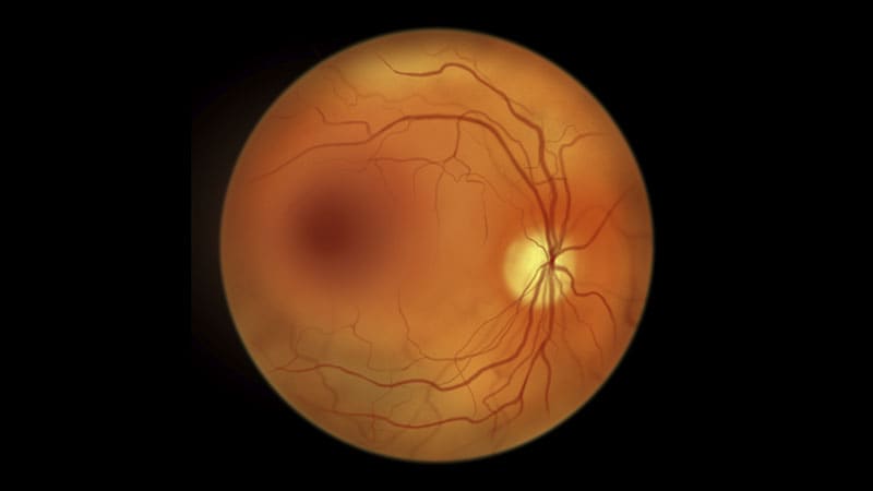 Inexpensive HIV Med Improves Vision in Diabetic Eye Disease