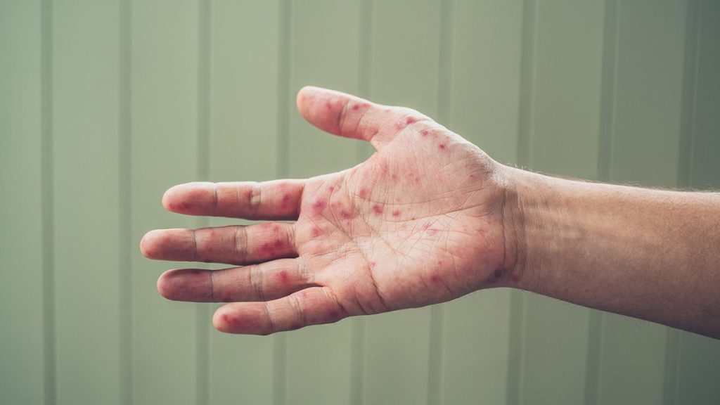 Infant born premature and infected with measles dies in Ontario