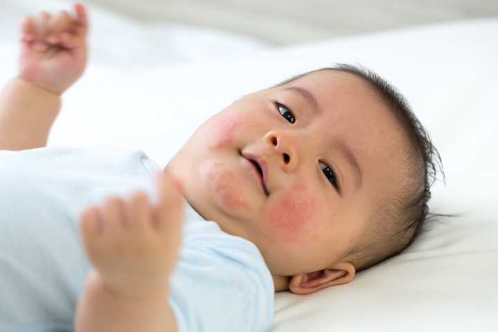 Lifestyle and Environment May Alter Power of Eczema Genes