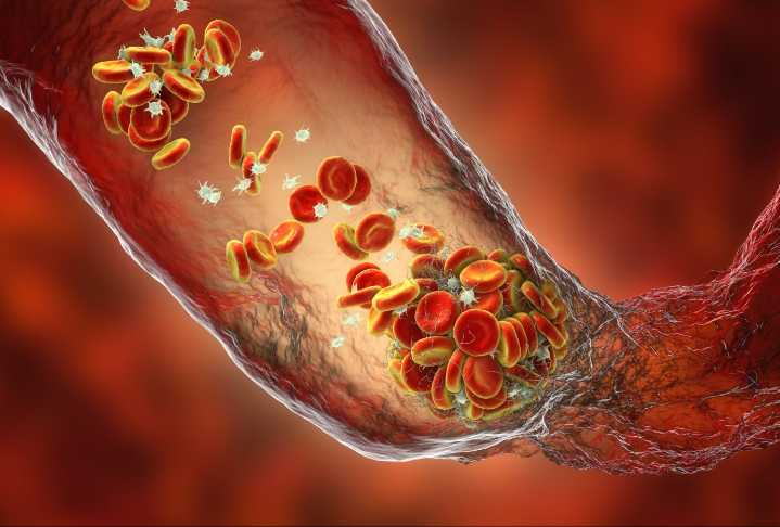 Genetic Risk Score Developed for Venous Thromboembolism