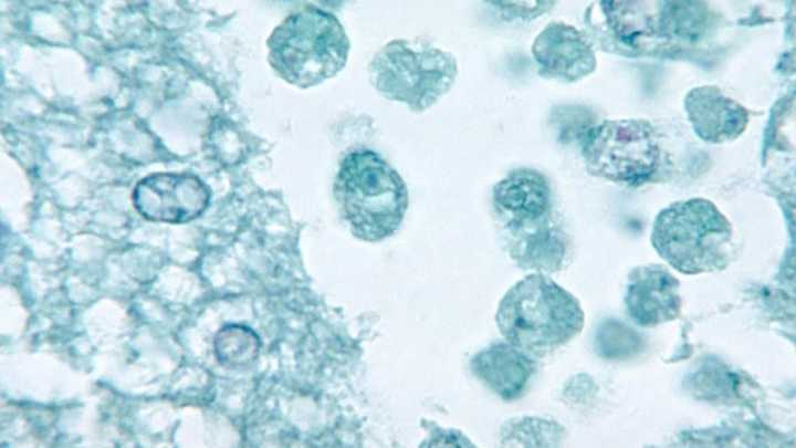 Mujer de Texas muere por peligrosa ameba comecerebro