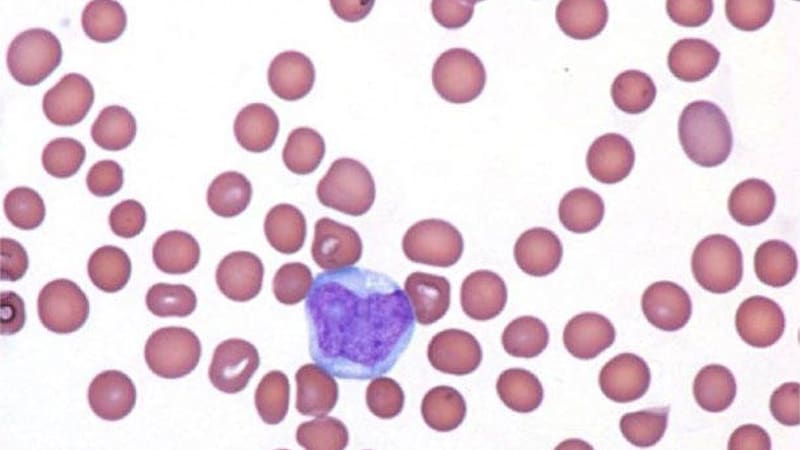PVEK: New Standard of Care in Rare, Deadly Blood Cancer?