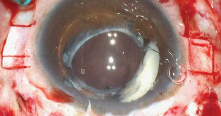 Points to consider for removal, management of Soemmering ring