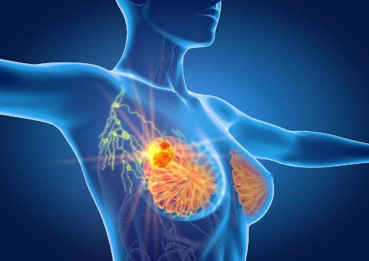 Nodal Irradiation Does Not Reduce Recurrence, Death for ypN0 Breast Cancer