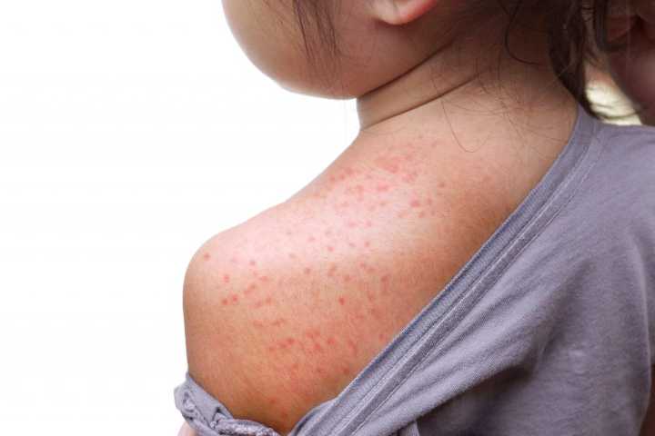 ND Leads U.S. In Confirmed Measles Cases