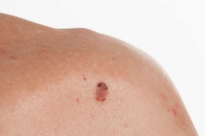 Positive Results for Libtayo as Adjuvant Treatment for Squamous Cell Carcinoma of the Skin