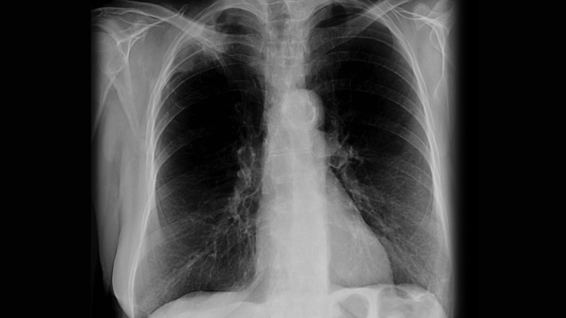Can a TKI Boost Anti-PD-L1 Activity in NSCLC?