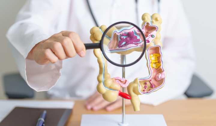 Stage III Colon Cancer Survival Improved by Anti