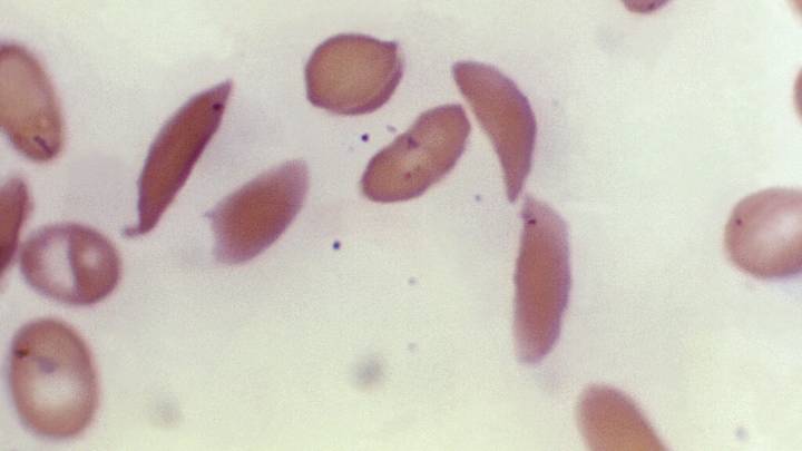 HHS cuts threaten a critical sickle cell disease program