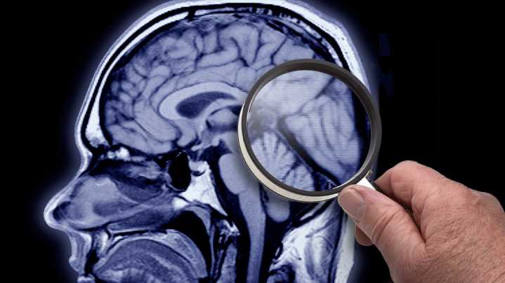 Health experts reflect on new FDA-approved Alzheimer's blood test
