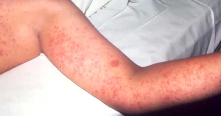 Two more Colorado measles infections connected to out
