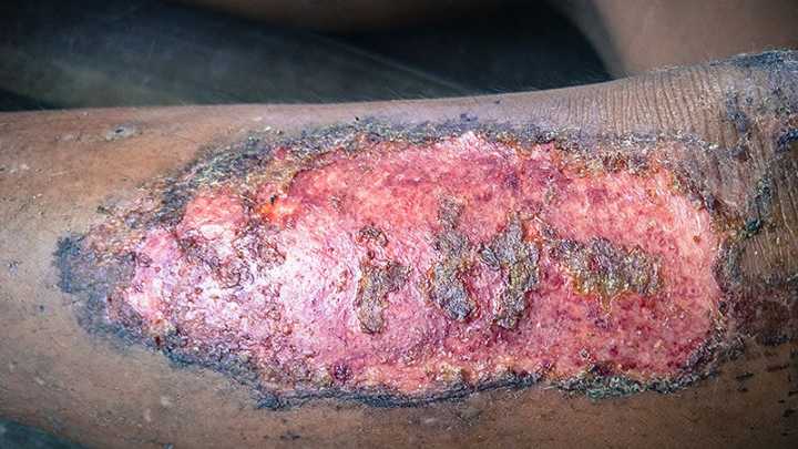 Rigosertib Shows Promise in EB-Associated Skin Cancer