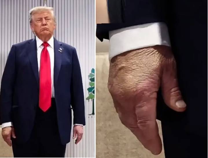 Trump presenta insuficiencia venosa crónica y hematomas