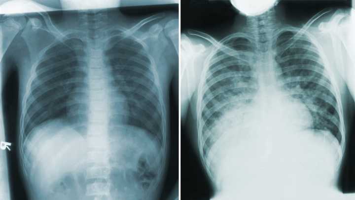 What to know about the pneumonic plague after Arizona patient’s death