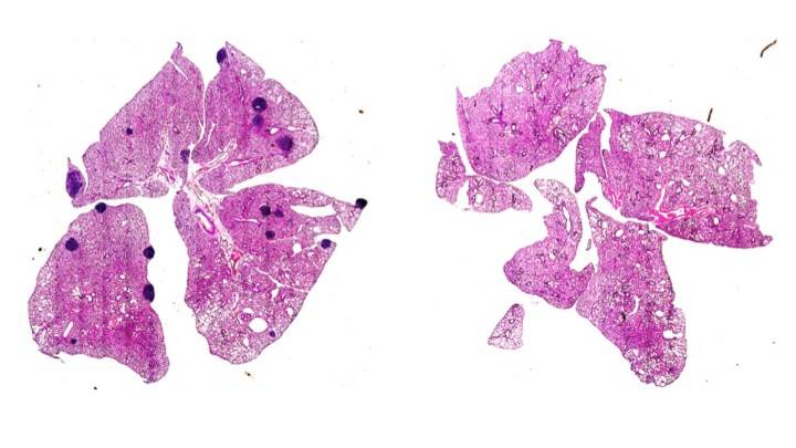 Científicos de Navarra dan con una clave para frenar recaídas contra el cáncer de mama más agresivo