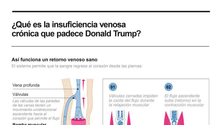 [Infografía] La Casa Blanca dice que Trump padece insuficiencia venosa, pero goza de buena salud